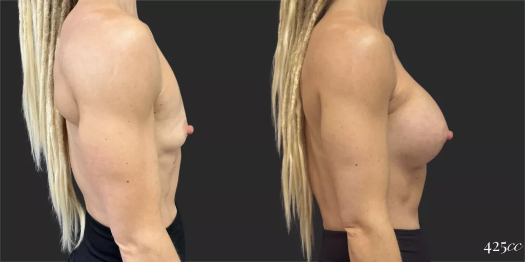 Breast Augmentation #015, before and after photo, view 3