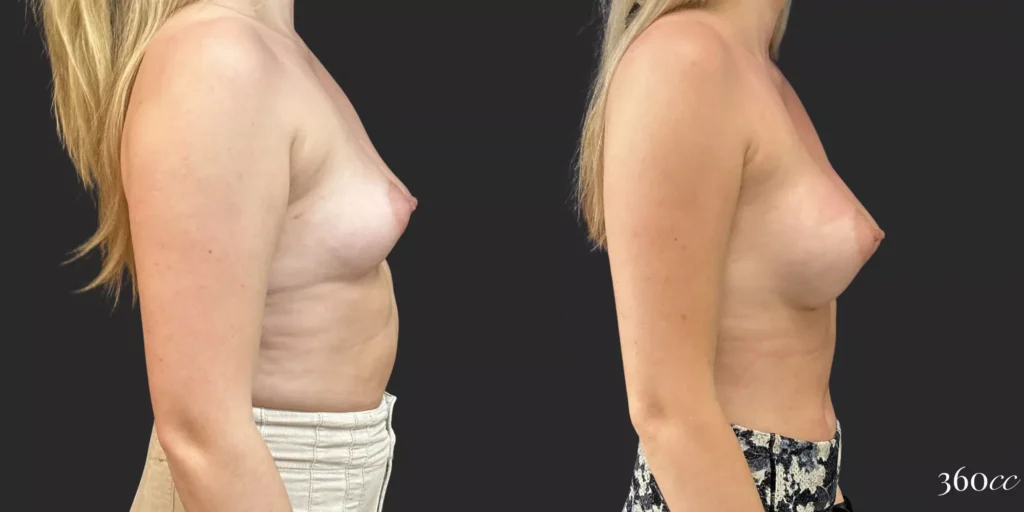 Breast Augmentation #017, before and after photo, view 3