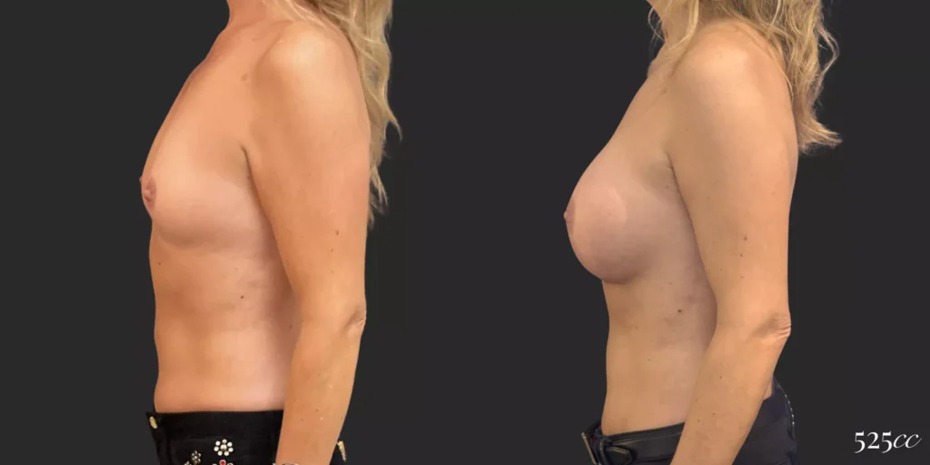 Breast Augmentation #020, before and after photo, view 3