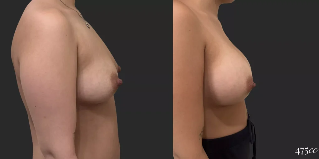 Breast Augmentation  #022, before and after photo, view 3