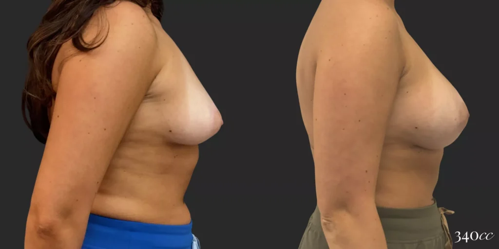 Breast Augmentation  #028, before and after photo, view 3