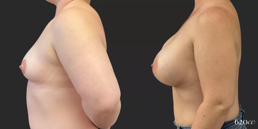 Breast Augmentation #031, before and after photo, view 3
