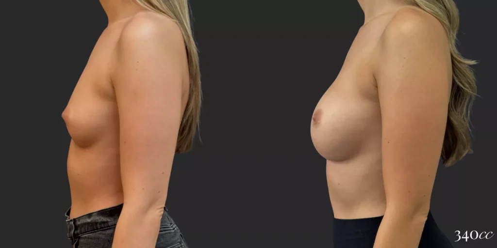 Breast Augmentation #032, before and after photo, view 3