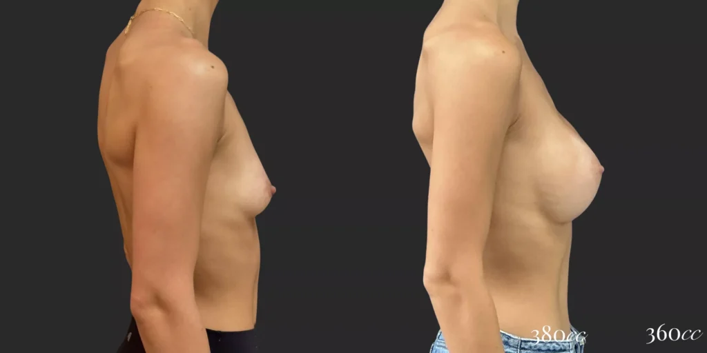 Breast Augmentation #034, before and after photo, view 3