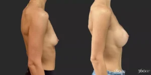 Breast Augmentation #034, before and after photo, view 3