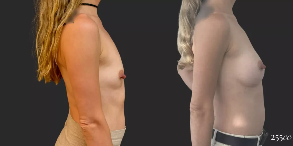 Breast Augmentation #038, before and after photo, view 3