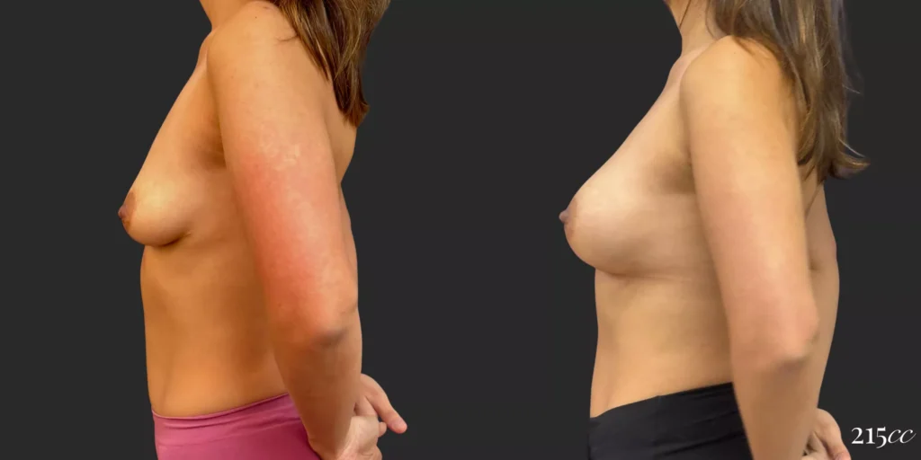 Breast Augmentation #044, before and after photo, view 3