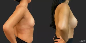 Breast Augmentation #045, before and after photo, view 3