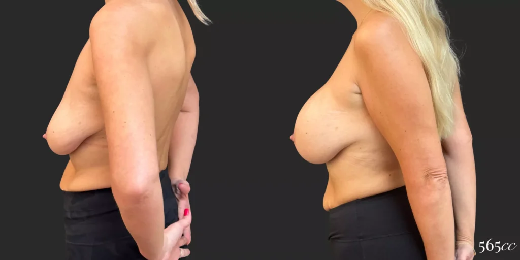 Breast Augmentation #046, before and after photo, view 3