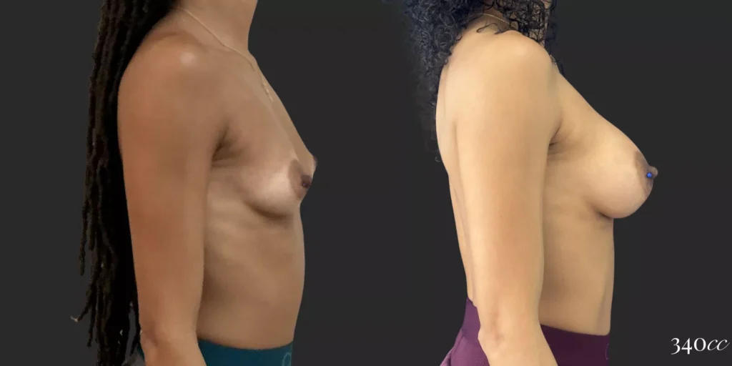 Breast Augmentation #047, before and after photo, view 3