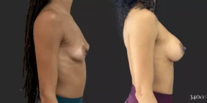 Breast Augmentation #047, before and after photo, view 3