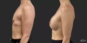 Breast Augmentation #049, before and after photo, view 3