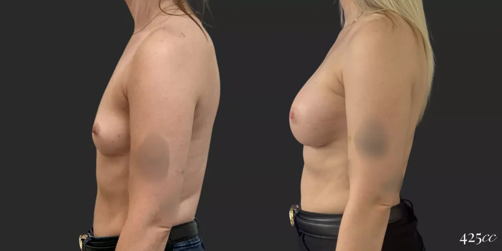 Breast Augmentation #050, before and after photo, view 3