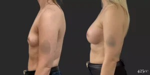 Breast Augmentation #050, before and after photo, view 3