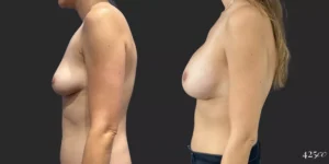 Breast Augmentation #052, before and after photo, view 3