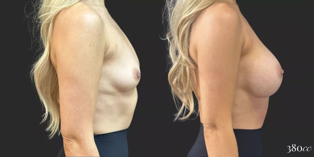 Breast Augmentation #053, before and after photo, view 3