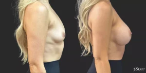 Breast Augmentation #053, before and after photo, view 3