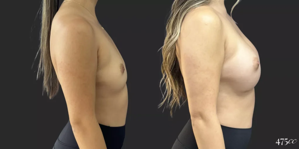 Breast Augmentation #055, before and after photo, view 3
