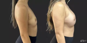 Breast Augmentation #055, before and after photo, view 3