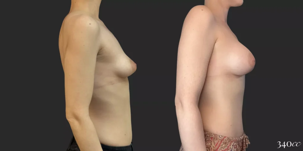 Breast Augmentation #056, before and after photo, view 3
