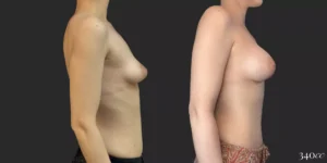 Breast Augmentation #056, before and after photo, view 3