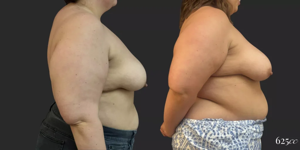 Breast Augmentation #057, before and after photo, view 3