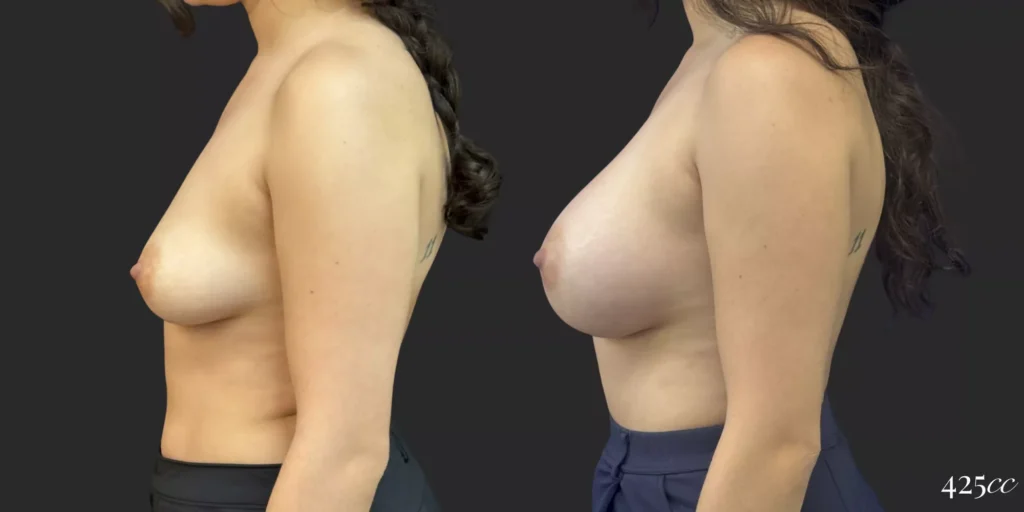 Breast Augmentation #058, before and after photo, view 3