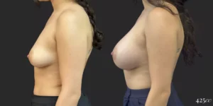Breast Augmentation #058, before and after photo, view 3