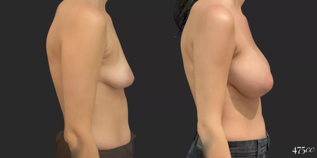 Breast Augmentation #059, before and after photo, view 3
