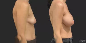 Breast Augmentation #059, before and after photo, view 3
