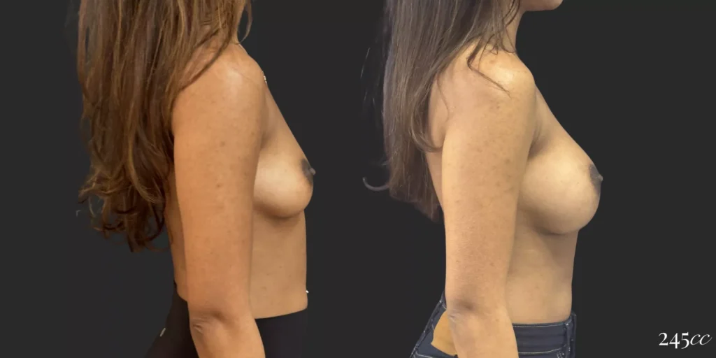 Breast Augmentation #060, before and after photo, view 3