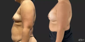 Breast Augmentation #062, before and after photo, view 3