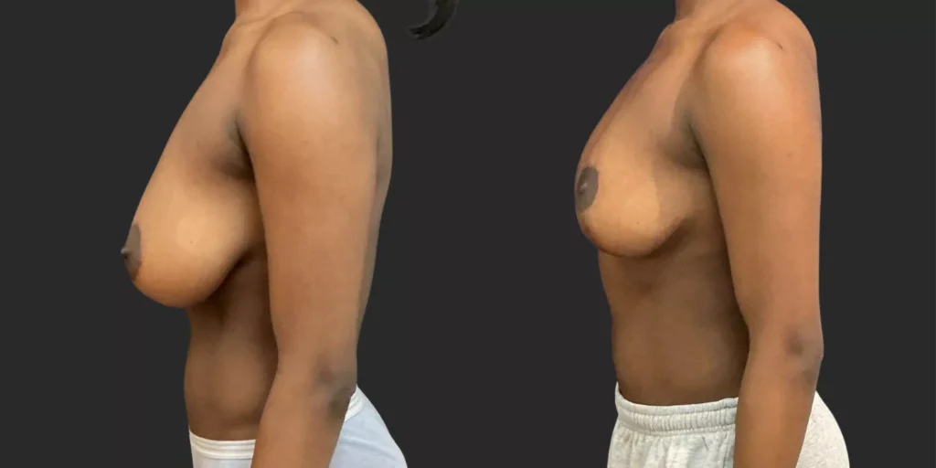 Breast Reduction #003, before and after photo, view 3