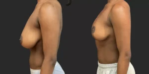 Breast Reduction #003, before and after photo, view 3