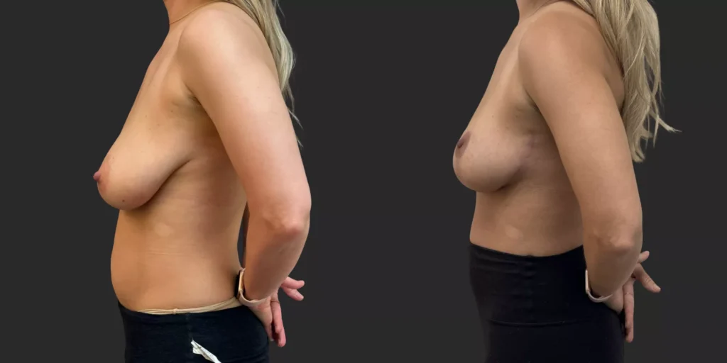 Breast Reduction #004, before and after photo, view 3