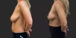 Breast Reduction #004, before and after photo, view 3