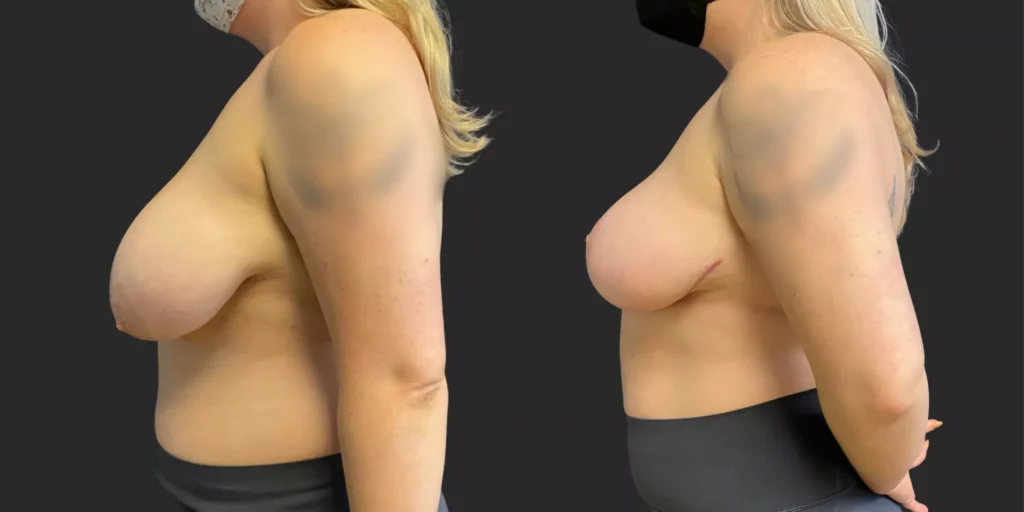 Breast Reduction #007, before and after photo, view 3