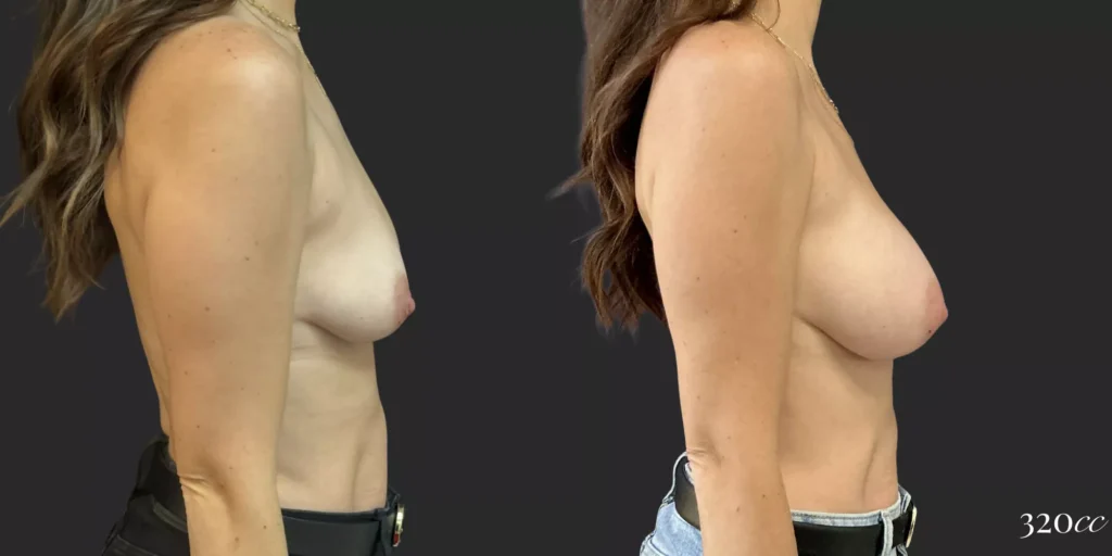 Breast Augmentation #016, before and after photo, view 3