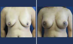 Breast Augmentation + Lift #004, before and after photo