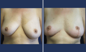 Breast Lift #004, before and after photo