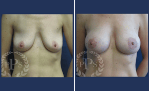 Breast Augmentation + Lift #005, before and after photo