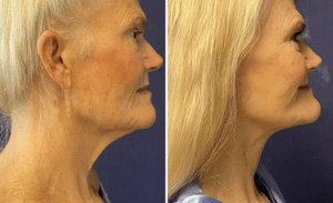 Face & Neck Lift #005, before and after photo