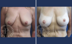 Breast Augmentation + Lift #006, before and after photo