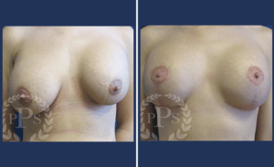 Breast Lift #006, before and after photo