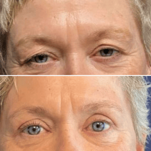 Eyelid Lift #007, before and after photo