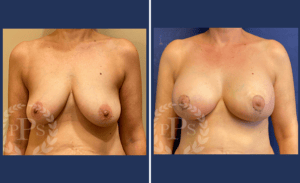 Breast Augmentation + Lift #007, before and after photo