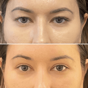 Eyelid Lift #009, before and after photo