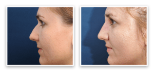 Non-Surgical Nose Reshaping #001, before and after photo, view 3
