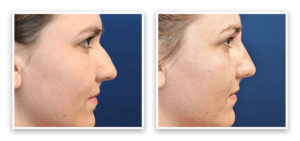 Non-Surgical Nose Reshaping #001, before and after photo, view 2