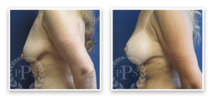 Breast Augmentation + Lift #006, before and after photo, view 3